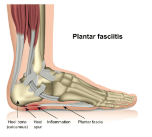 Plantar Fasciitis diagram